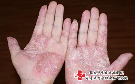 银屑病不同分期病因图片