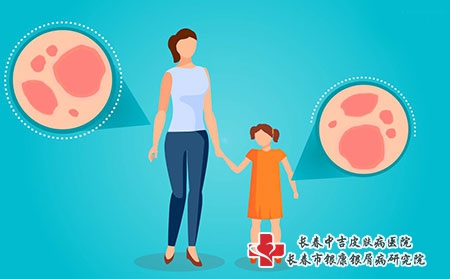 治疗银屑病的谣言是什么？