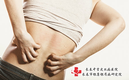 关节病型牛皮癣的危害有什么