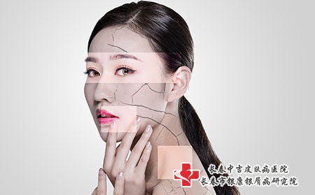 哪种方法治疗牛皮癣效果好