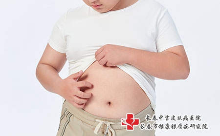 孩子头上长了红疹是牛皮癣吗