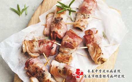 如何预防牛皮癣疾病复发呢?