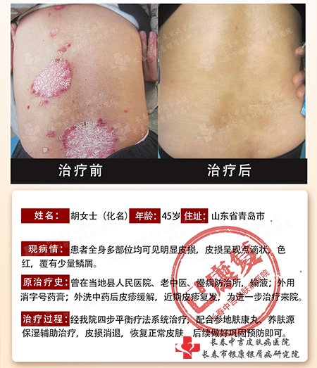 10月1日-7日长春银康医院举行“庆国庆筑梦皮肤健康·多专家联合会诊公益活动”