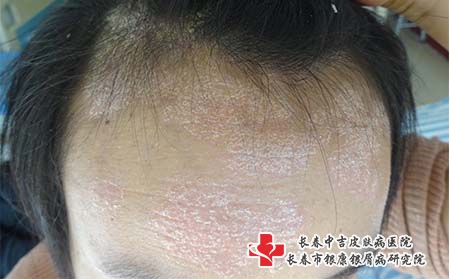 [长春治疗牛皮癣专业医院]银屑病平时怎么护理呢?