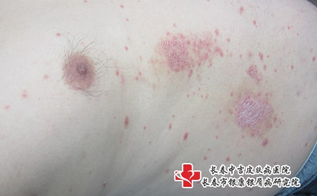 长春牛皮癣医院治牛皮癣费用多少钱？长春中吉银屑病医院位置