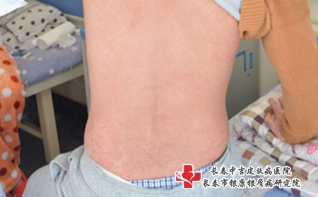 长春治疗牛皮癣医院排行?怎么护理银屑病是有效的呢?