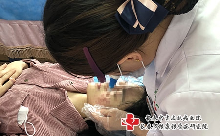 长春牛皮癣怎么治-长春什么地方能治银屑病