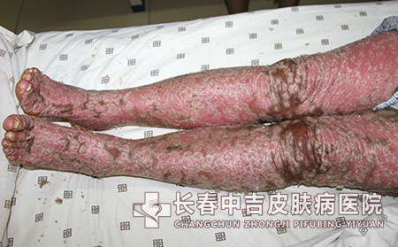 日常生活中牛皮癣早期症状是什么呢