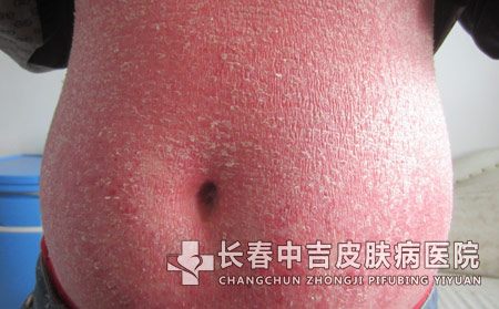 寻常型牛皮癣有哪些治疗的常识