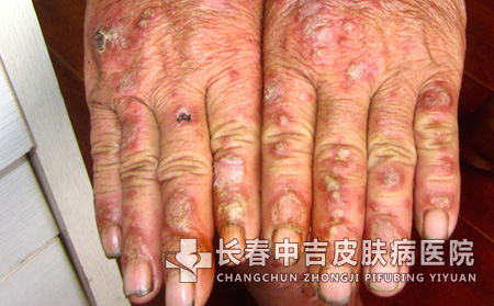 牛皮癣疾病对患者会造成哪些心理危害