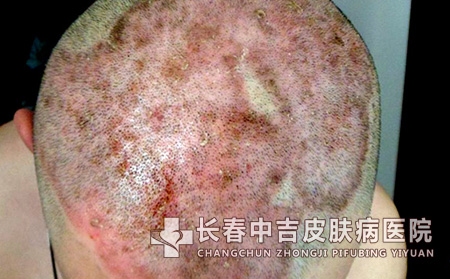 银屑病会对患者有哪些影响