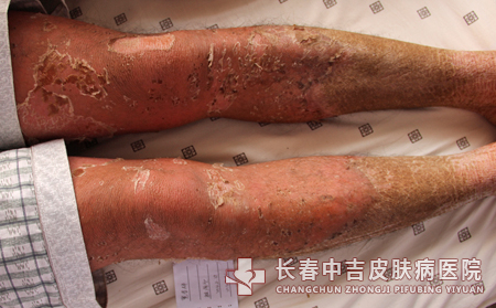 牛皮癣患者有怎样的症状呢