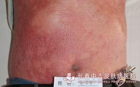 长春红皮型银屑病该怎么治疗能恢复