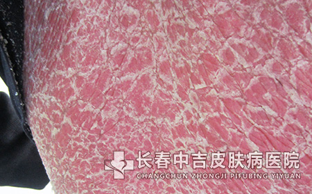 得上红皮病型牛皮癣要如何去治疗不错？