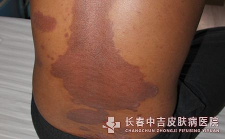 银屑病患者合适吃的蔬菜有哪些