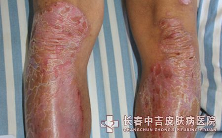 脓疱型银屑病的症状都有什么