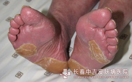 患上了牛皮癣会有什么样的危害