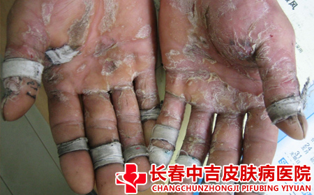手足银屑病跟什么因素有关