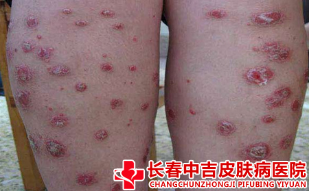 银屑病患者为什么不能穿短裤