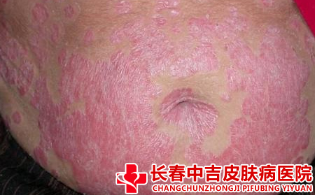 长春市不错的牛皮癣医院护理可不合适