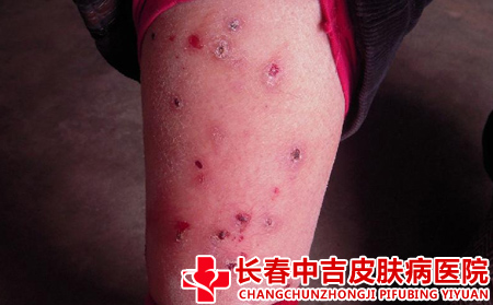 诱发银屑病的原因是什么
