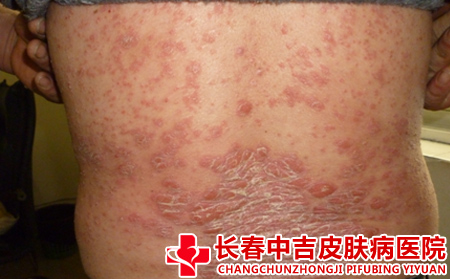 长春哪家医院治疗银屑病比较便宜