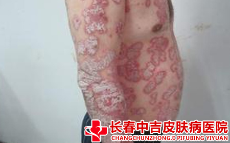 长春脓包型银屑病的是否效果不错的医院是