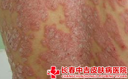 喝酒跟银屑病有什么关系