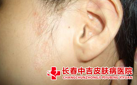 孩子得银屑病跟哪些方面有关系