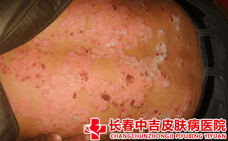 牛皮癣的成因是什么呢