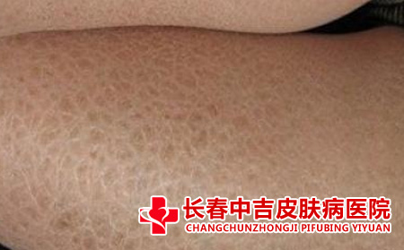 怎样预防牛皮癣的发生