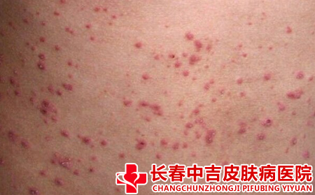 四肢银屑病还能治合适不