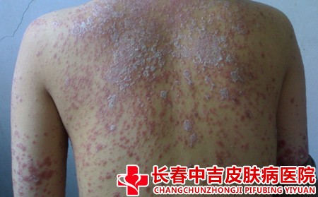 手脚得了银屑病对生活和工作的影响有哪些