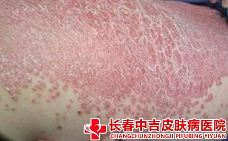 容易导致银屑病发生的原因有哪些