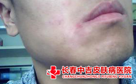 怎么控制不错脸上一小块的牛皮癣