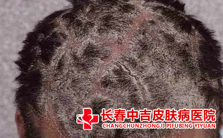 头上的牛皮癣治疗起来难度大吗