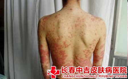 导致银屑病发生的原因有什么