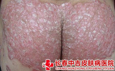 银屑病应该怎么进行治疗