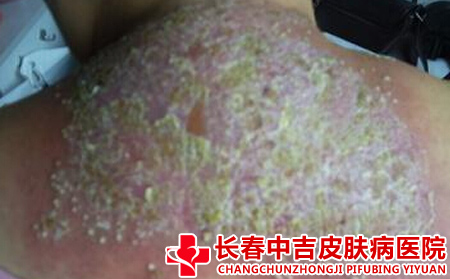 银屑病发生的原因有什么