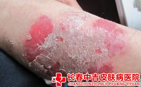 那个医院治疗银屑病