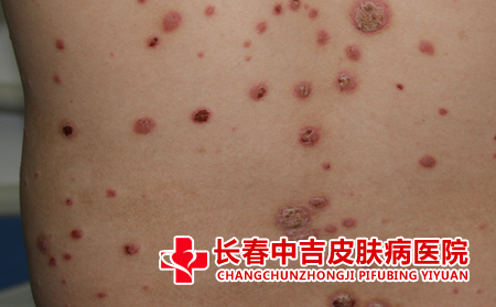 银屑病的日常护理方式有什么