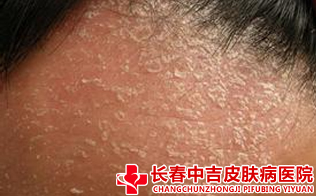 导致银屑病发生的原因有什么