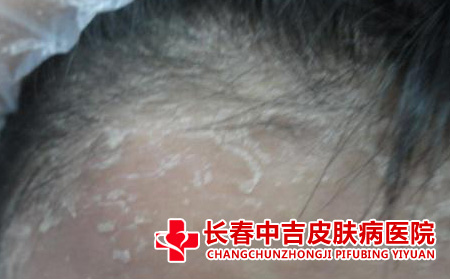 头部银屑病应该怎么进行治疗