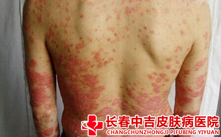 银屑病患者的护理方式