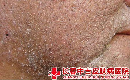 导致银屑病的原因有什么