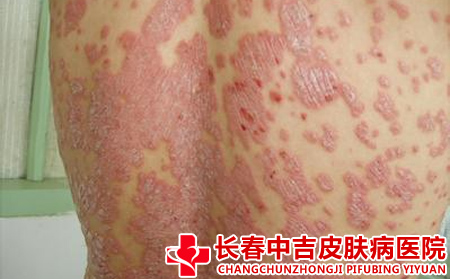 银屑病患者应该怎么注意护理