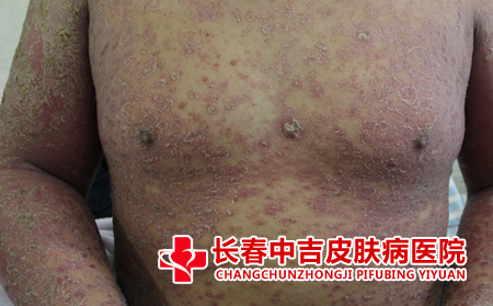 银屑病患者应该怎么进行护理