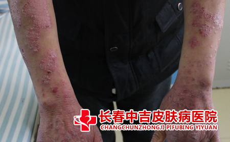 银屑病患者应该注意什么