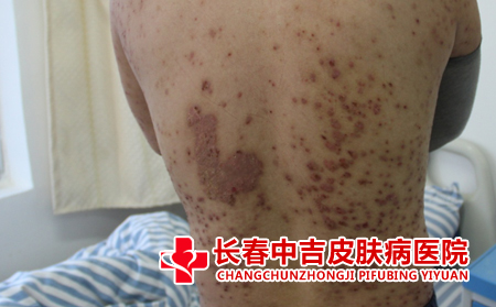 银屑病怎么进行护理