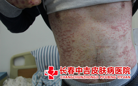 银屑病的症状都有什么